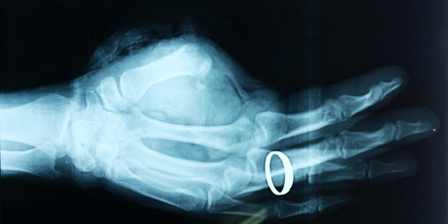 Noi ngon tay thanh cong cho mot benh nhan o Nghe An