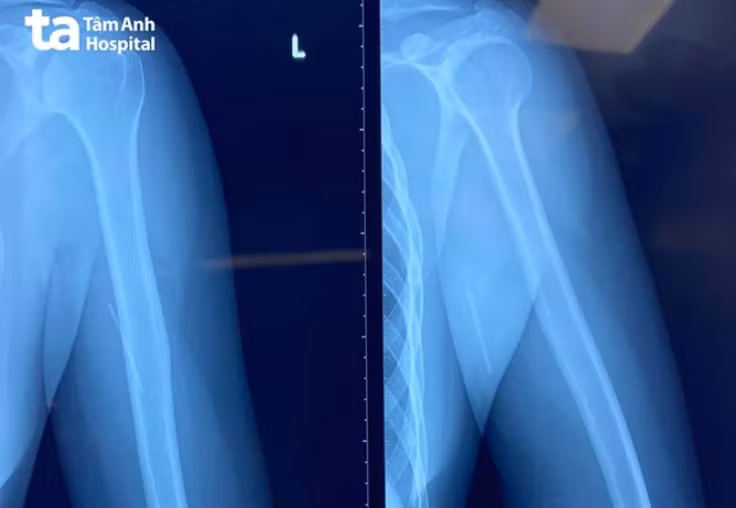 Hy hữu: Que tránh thai đi lạc sâu vào bắp tay Hy huu: Que tranh thai di lac sau vao bap tay