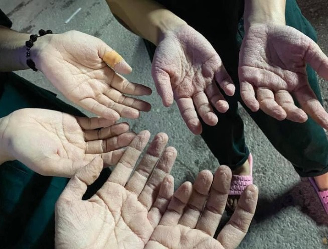 Những đôi bàn tay nhăn nhúm, tái nhợt do ngâm trong mồ hôi của chính mình, dưới lớp đồ bảo hộ nhiều giờ đồng hồ.