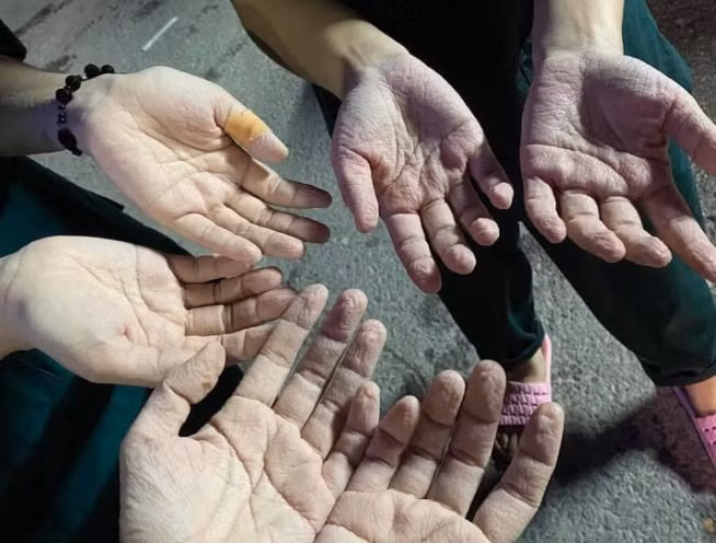 Những đôi bàn tay nhăn nhúm, tái nhợt do ngâm trong mồ hôi của chính mình, dưới lớp đồ bảo hộ nhiều giờ đồng hồ.