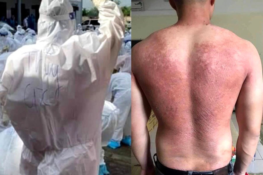 Tấm lưng phồng rộp, đỏ rực của một nam nhân viên y tế sau thời gian vận đồ bảo hộ kín mít dưới thời tiết nắng nóng.