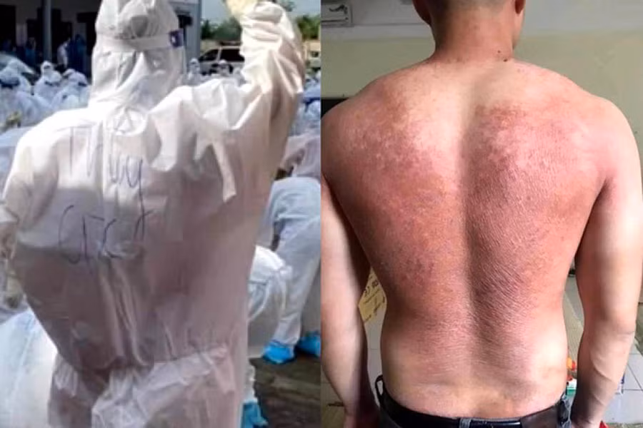 Tấm lưng phồng rộp, đỏ rực của một nam nhân viên y tế sau thời gian vận đồ bảo hộ kín mít dưới thời tiết nắng nóng.