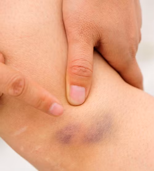 Vết bầm tím không rõ nguyên nhân. Nếu bạn thường xuất hiện vết bầm không rõ nguyên nhân thì nên đến gặp bác sĩ. Những vết bầm này là dấu hiệu cơ thể thiếu vitamin. Đôi khi, nó cũng có thể là dấu hiệu bệnh lý nghiêm trọng như bệnh đông máu,...