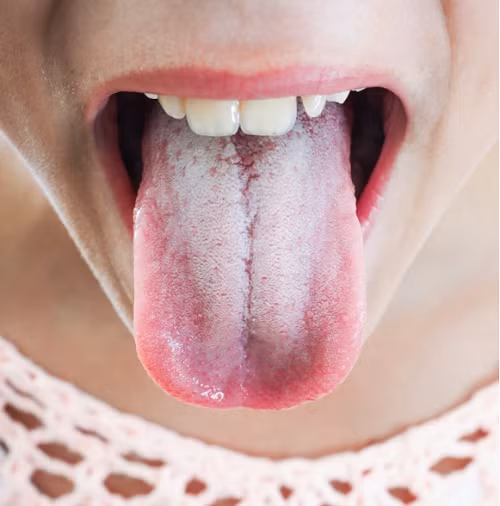 Mảng trắng trên lưỡi. Lưỡi khỏe mạnh sẽ có màu hồng nhạt. Trong khi đó, lưỡi có nhiều mảng trắng có thể là dấu hiệu của bệnh tưa lưỡi – bệnh rất phổ biến ở bệnh nhân tiểu đường. Các mảng bám này cũng có thể là dấu hiệu của việc chăm sóc răng miệng chưa kỹ, cần đánh răng sạch để cải thiện.