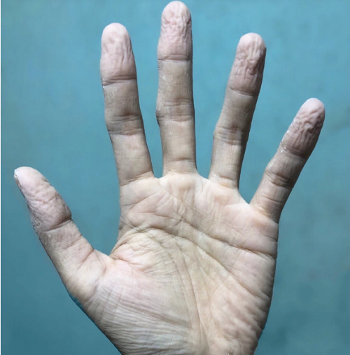 Bàn tay và ngón tay nhăn nheo. Tình trạng bàn tay và ngón tay nhăn nheo là dấu hiệu lão hóa bình thường. Nó cũng xảy ra khi chúng ta ngâm mình trong nước quá lâu, không đáng lo ngại.