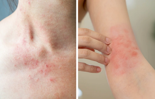 Phát ban da. Da ngứa, đỏ thường là dấu hiệu của bệnh chàm. Trường hợp phát ban kèm sốt có thể do nhiễm trùng hoặc dị ứng. Dù trường hợp nào, bạn cũng cần được bác sĩ theo dõi bởi những nốt ban rất dễ bị viêm.