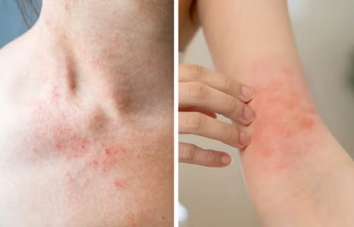 Phát ban da. Da ngứa, đỏ thường là dấu hiệu của bệnh chàm. Trường hợp phát ban kèm sốt có thể do nhiễm trùng hoặc dị ứng. Dù trường hợp nào, bạn cũng cần được bác sĩ theo dõi bởi những nốt ban rất dễ bị viêm.