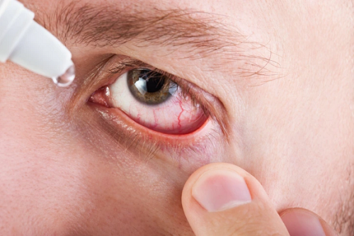 Khô mắt. Khô mắt gây cảm giác nóng rát, viêm và tổn thương mắt. Khô mắt có thể bắt nguồn từ lão hóa hoặc do một số loại thuốc gây ra. Điều đáng bàn, nó có thể là dấu hiệu của hội chứng Siogren. Siogren thường đi kèm chứng khô miệng, là tình trạng rối loạn hệ miễn dịch.