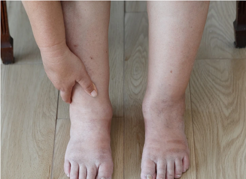 Sưng mắt cá chân. Sưng mắt cá chân là một dấu hiệu phổ biến của thai kỳ. Nếu bạn không mang thai, nó có thể là dấu hiệu của tuần hoàn kém, các vấn đề về tim hoặc tuyến giáp. Ngoài ra, ăn quá nhiều muối cũng gây hiện tượng giữ nước, sưng mắt cá chân.