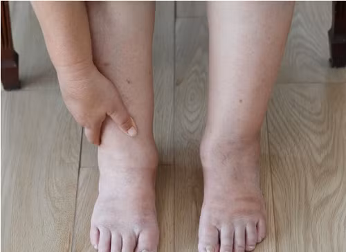 Sưng mắt cá chân. Sưng mắt cá chân là một dấu hiệu phổ biến của thai kỳ. Nếu bạn không mang thai, nó có thể là dấu hiệu của tuần hoàn kém, các vấn đề về tim hoặc tuyến giáp. Ngoài ra, ăn quá nhiều muối cũng gây hiện tượng giữ nước, sưng mắt cá chân.