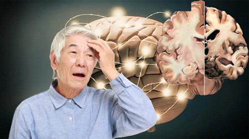 4. Bệnh Alzheimer. Alzheimer là bệnh rối loạn thần kinh, khiến cho các tế bào não chất dần, não teo nhỏ. Alzheimer là chứng bệnh nguy hiểm nhưng vẫn chưa có cách chữa khỏi hoàn toàn. Các loại thuốc hiện tại chỉ giúp làm chậm quá trình suy giảm nhận thức.