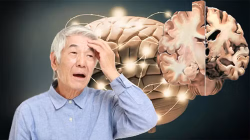 4. Bệnh Alzheimer. Alzheimer là bệnh rối loạn thần kinh, khiến cho các tế bào não chất dần, não teo nhỏ. Alzheimer là chứng bệnh nguy hiểm nhưng vẫn chưa có cách chữa khỏi hoàn toàn. Các loại thuốc hiện tại chỉ giúp làm chậm quá trình suy giảm nhận thức.