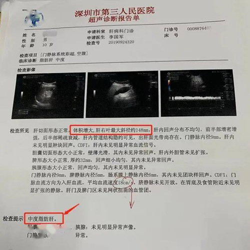 Tre 11 tuoi xo gan nang vi thoi quen an uong nay