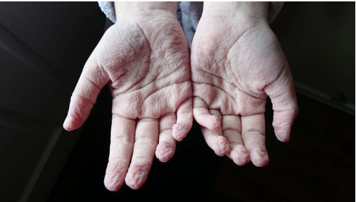 Tuy nhiên, nếu ngón tay nhăn nheo, mất độ đàn hồi nhanh hơn các bộ phận khác, không phải do ngâm nước thì cần cảnh giác. Đây là dấu hiệu bệnh hiểm như mất nước, tuần hoàn máu kém hoặc có vấn đề về tuyến giáp.