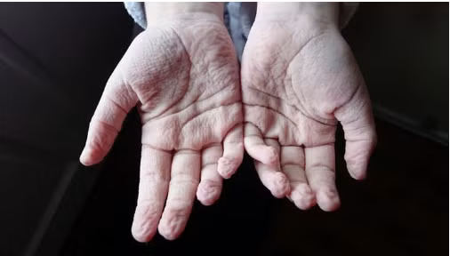 Tuy nhiên, nếu ngón tay nhăn nheo, mất độ đàn hồi nhanh hơn các bộ phận khác, không phải do ngâm nước thì cần cảnh giác. Đây là dấu hiệu bệnh hiểm như mất nước, tuần hoàn máu kém hoặc có vấn đề về tuyến giáp.