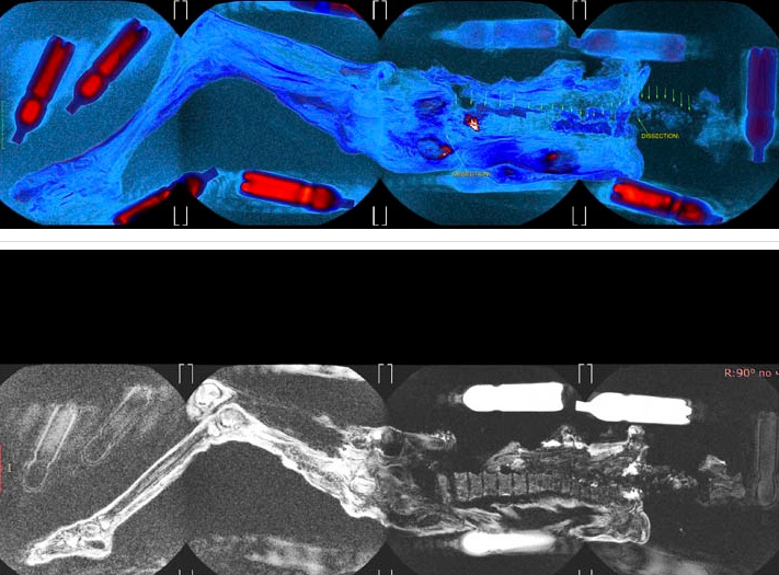 Kết quả chụp MRI cho thấy cô mắc ung thư vú giai đoạn cuối và viêm tủy xương, có thể là nguyên nhân chính dẫn đến cái chết khi mới 20-30 tuổi.(Ảnh: Dân việt)