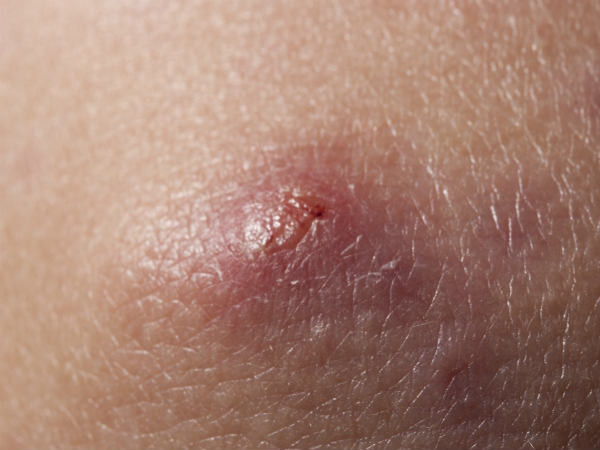 Đau kéo dài, da khó lành: Ung thư da ác tính hay ung thư biểu mô tế bào là những bệnh gây ra những dấu hiệu như trên.