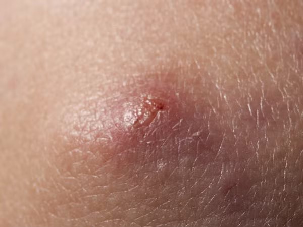 Đau kéo dài, da khó lành: Ung thư da ác tính hay ung thư biểu mô tế bào là những bệnh gây ra những dấu hiệu như trên.