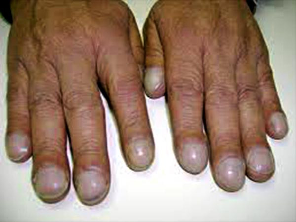 Móng tay xuất hiện bất thường: Đột nhiên dưới chấm móng tay xuất hiện vệt nâu, đen có thể là dấu hiệu của bệnh ung thư da. Bên cạnh đó, nếu móng tay đột nhiên sẫm màu, cong xuống bất thường cũng có thể là dấu hiệu của bệnh ung thư phổi.