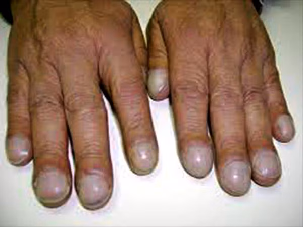 Móng tay xuất hiện bất thường: Đột nhiên dưới chấm móng tay xuất hiện vệt nâu, đen có thể là dấu hiệu của bệnh ung thư da. Bên cạnh đó, nếu móng tay đột nhiên sẫm màu, cong xuống bất thường cũng có thể là dấu hiệu của bệnh ung thư phổi.