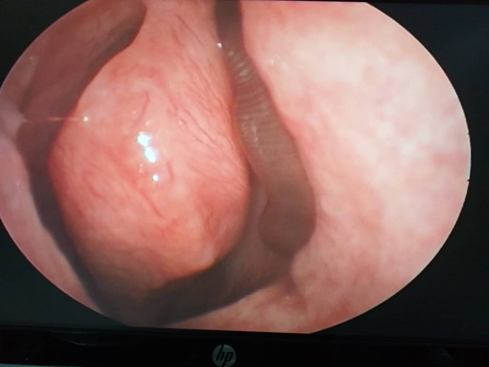 Lien tuc chay mau mui, nguoi dan ong di kham phat hien di vat khung khiep