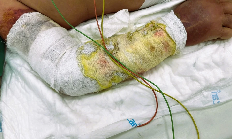 Vi sao nganh ca tre co the gay hoai tu da, nhiem khuan huyet?