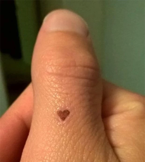 10. Vết sẹo trên tay tôi hình trái tim.