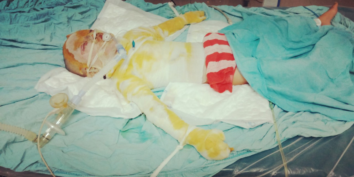 Xot xa hoan canh be gai 5 tuoi bi bong nang