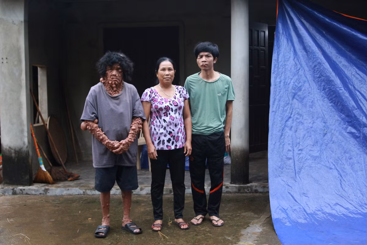 Tam su nhoi long cua nguoi dan ong co hang ngan khoi u tren nguoi-Hinh-2