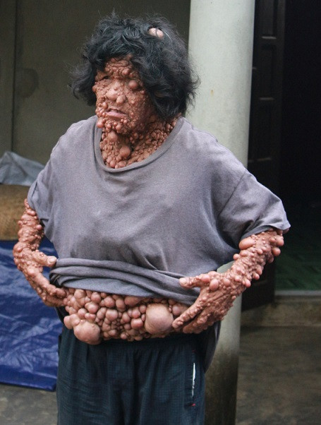 Tam su nhoi long cua nguoi dan ong co hang ngan khoi u tren nguoi-Hinh-3