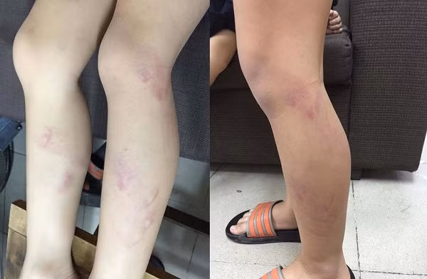 HN: Hoc sinh tieu hoc bi co giao dung thuoc danh tim chan