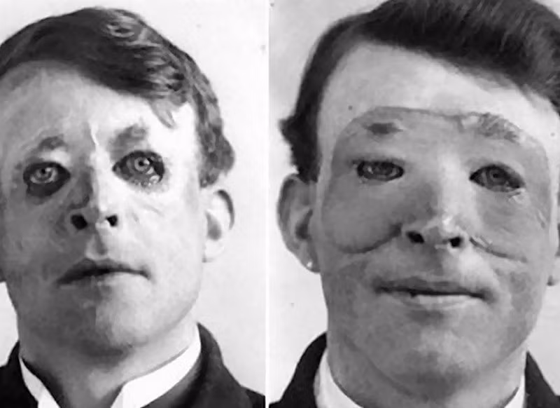 Thủy thủ người Anh Walter Yeo là người đầu tiên được thực hiện phẫu thuật thẩm mỹ tiên tiến, cụ thể là cấy ghép da. Người này bị chấn thương nghiêm trọng khi tham gia trận hải chiến Jutland năm 1916. Đây là bức ảnh rùng rợn ghi lại gương mặt của thủy thủ Walter Yeo bị hủy dung trong chiến sự.