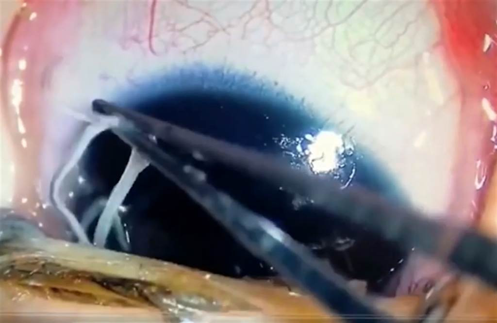 Rung minh ky sinh trung ngo nguay trong mat tu... om ap quen thuoc