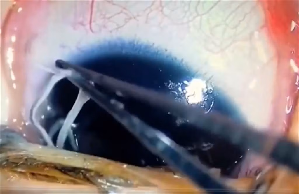 Rung minh ky sinh trung ngo nguay trong mat tu... om ap quen thuoc