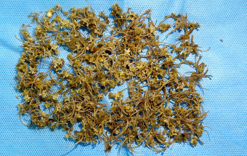 Nguoi dan ong bi tac ruot do nuot hang ngan manh xuong ran