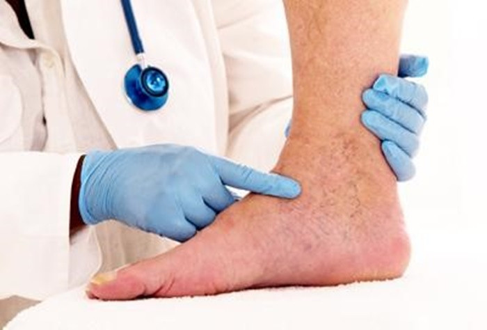 Che do dinh duong cho nguoi benh huyet khoi tinh mach sau