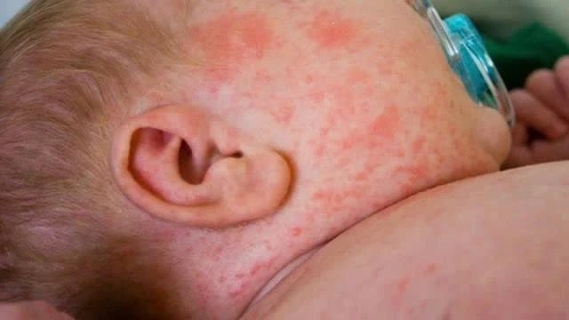 Dich soi nghiem trong nhat trong nhieu nam tai My