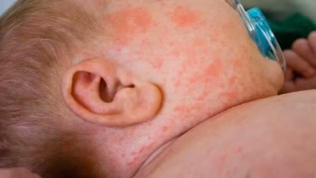 Dich soi nghiem trong nhat trong nhieu nam tai My