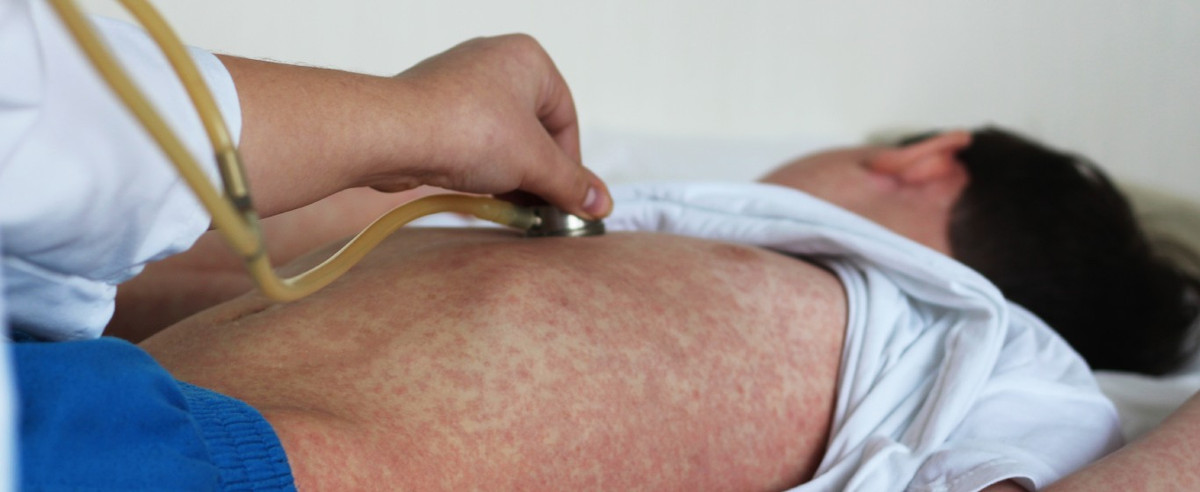 Ca nuoc them 2 ca tu vong do mac soi trong tuan qua