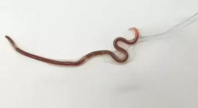 Hai hung bac si gap con giun dai 38mm tu mieng mot phu nu