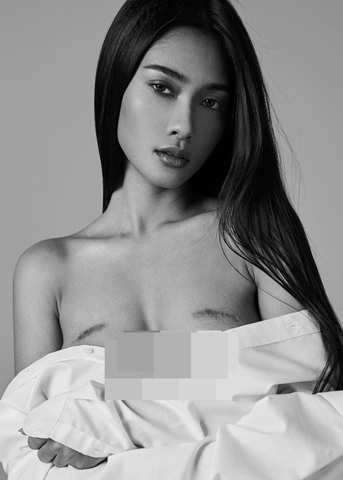 Vết sẹo không phải là trở ngại của Thuzar Wint Lwin khi cô làm người mẫu cũng như tham gia các cuộc thi nhan sắc.