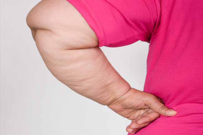 Các vấn đề về da: Béo phì có thể gây ra một số vấn đề về da. Sự thay đổi hormone có thể khiến vùng da ở cổ và các phần gập của cơ thể bị sạm và chảy nhão; đồng thời sự căng da có thể gây các vết rạn.