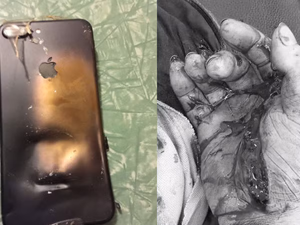 Thanh niên 19 tuổi phải cắt bỏ 3 ngón tay vì điện thoại phát nổ Thanh nien 19 tuoi phai cat bo 3 ngon tay vi dien thoai phat no