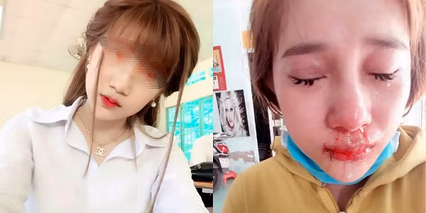 Theo như những gì V.C.H đăng tải thì H.M.V và S.N đã chia tay, tuy nhiên nam thanh niên là người níu kéo, thậm chí dọa nạt, ép buộc bạn gái cũ nếu không chịu qua nhà ngủ cùng sẽ thuê người hack facebook sau đó đăng bài 'bóc phốt'. Thế nhưng S.N vẫn nhất quyết không chịu nên nam thanh niên đã đăng bài nói xấu, vạch trần người yêu cũ trên mạng xã hội rồi nhân cơ hội đó gạ S.N phải đích thân đến tận nhà xin lỗi thì sẽ đưa điện thoại cho S.N tự tay xóa bài đăng trên Facebook. Và khi S.N tới nơi đã bị bạn trai cũ đánh đập khiến mũi cô bị méo sang một bên và dập môi đến chảy máu. Sự việc còn khiến các cư dân mạng tức giận hơn khi H.M.V chối bỏ hoàn toàn trách nhiệm cũng như hành động của mình sau khi bị S.N đòi bồi thường, báo công an. Thậm chí, nam thanh niên còn liên tục đăng status phản pháo, thanh minh cho bản thân trên trang cá nhân.