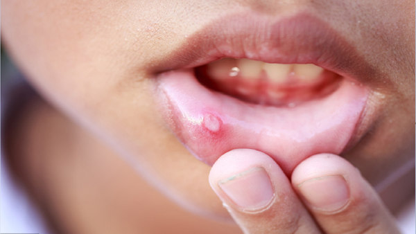 4. Vết loét miệng lâu ngày. Loét miệng là tổn thương niêm mạc cục bộ, liên quan đến nhiệt, bỏng hoặc dạ dày kém. Điều trị đúng cách, vết loét sẽ tiến triển tốt sau 1 tuần. Vậy nhưng, vết loét do các bệnh lý ác tính như ung thư miệng, ung thư vòm họng, ung thư máu... thường có diện tích lớn, không dễ lành và tái đi tái lại nhiều lần. (Ảnh: Toutiao)