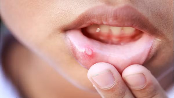 4. Vết loét miệng lâu ngày. Loét miệng là tổn thương niêm mạc cục bộ, liên quan đến nhiệt, bỏng hoặc dạ dày kém. Điều trị đúng cách, vết loét sẽ tiến triển tốt sau 1 tuần. Vậy nhưng, vết loét do các bệnh lý ác tính như ung thư miệng, ung thư vòm họng, ung thư máu... thường có diện tích lớn, không dễ lành và tái đi tái lại nhiều lần. (Ảnh: Toutiao)