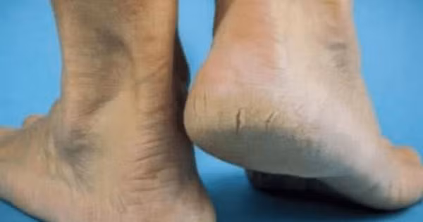 1. Đau gót chân. Đau gót chân thường xảy ra khi đứng nhiều, chơi thể thao bị chấn thương, hoạt động quá sức, bị gai gót chân, viêm gân, viêm dây chằng và yếu thận. (Ảnh: Aboluowang)