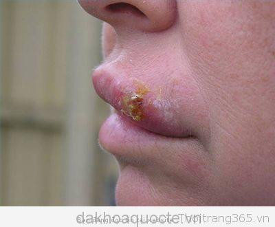 Việc vệ sinh sau khi quan hệ không thể loại bỏ được yếu tố nguy cơ lây nhiễm sùi mào gà.