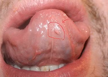 Nhiều quý ông hay có quan hệ ngoài luồng thường tự an ủi rằng nếu vệ sinh sạch sẽ sau khi quan hệ sẽ không mắc sùi mào gà. Nhưng đây là quan niệm sai hoàn toàn vì virus HPV chứa trong tinh dịch và dịch âm đạo của nam và nữ, nó sẽ tác động vào tế bào trong quá trình quan hệ tình dục.