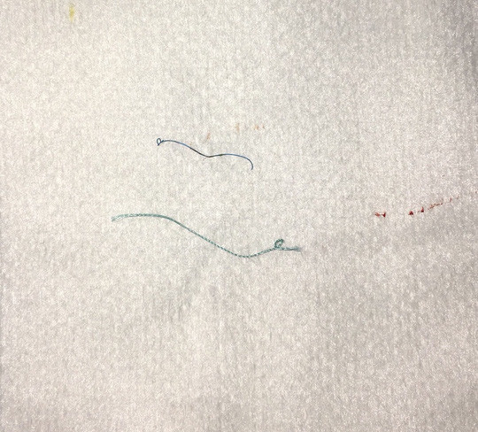 Mat mo, sung ne sau nhan mi, co gai hoang hon khi bac si lay ra vat nay-Hinh-2